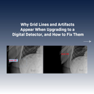 X-ray grid lines and artifacts appearing after upgrading to a digital detector compared to a clean image with the grid removed.