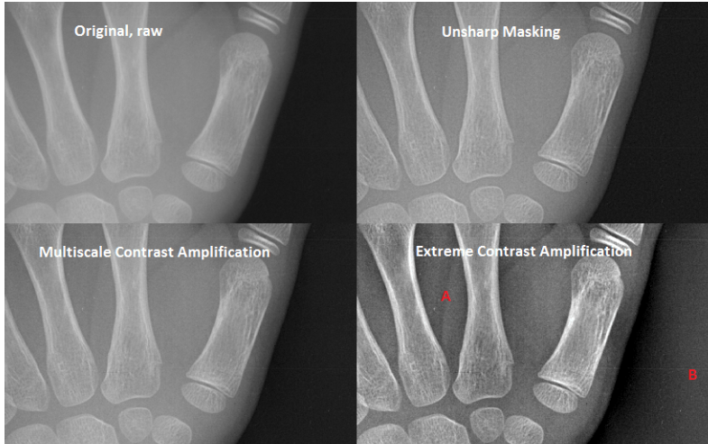 Comparison of X-ray image enhancement techniques on a hand radiograph, showing Original raw image, Unsharp Masking, Multiscale Contrast Amplification, and Extreme Contrast Amplification